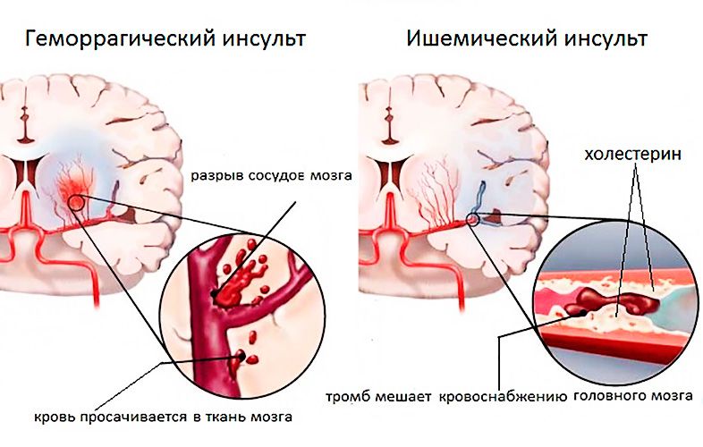 бросил пить болят мышцы